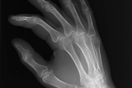 Arthroscopic Thumb Joint Replacement | Orange County Surgeons
