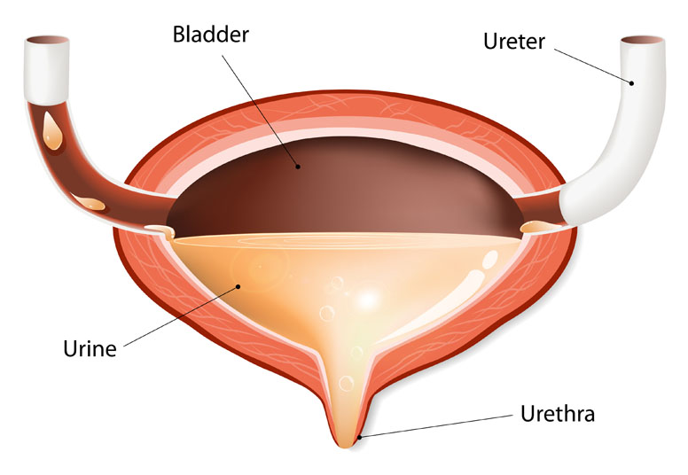 What is involved in bladder suspension surgery?