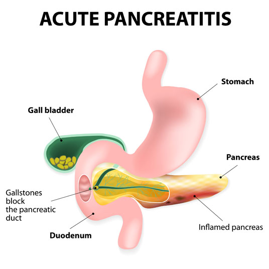 pancreatic pseudocyst drainage