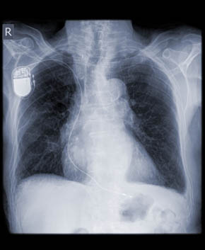 upper chest passmaker inplantation