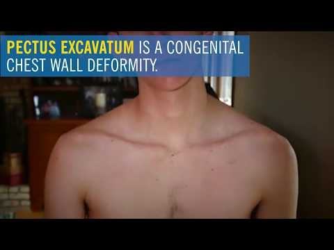 Pectus Excavatum - What It Is And The Unique Way Doctors Treat It
