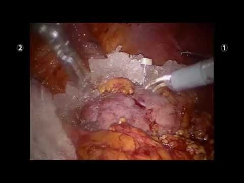 Ice Cooling The Kidney Intracorporeally During Robotic Partial Nephrectomy