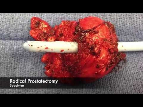 Robotics And The Perineal Approach To Radical Prostatectomy