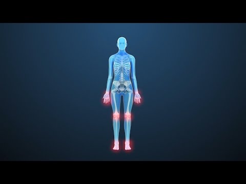 Rheumatoid Arthritis: Treatments for Stiff, Painful Joints