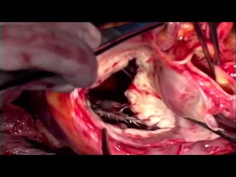 Have You Ever Wondered What Happens During a Heart Transplant?