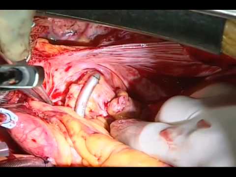 Atrial Fibrillation Surgical Ablation With Concomitant Surgery