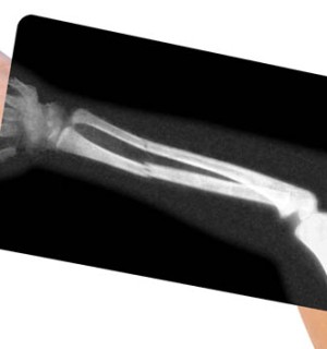 Plate and Screw Fixation of the Arm Bones
