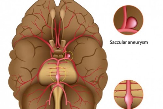Cerebral Aneurysm Repair by Occlusion and Bypass
