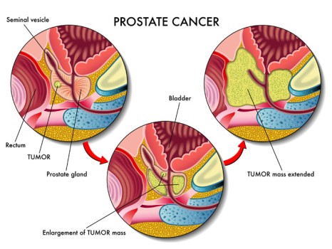 Low Dose Rate Brachytherapy for Prostate Cancer