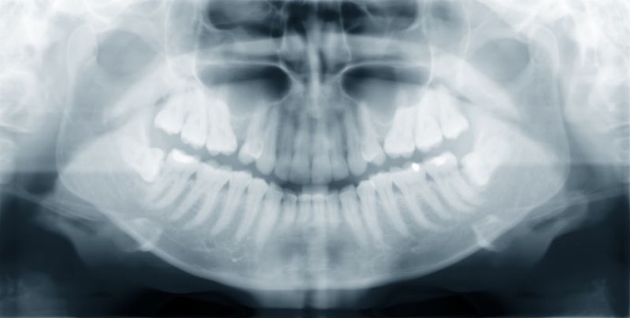 Mandibular Sagittal Split Osteotomy