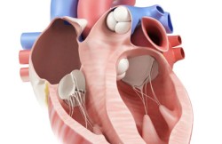 Minimally Invasive Pulmonary Artery Valve Repair