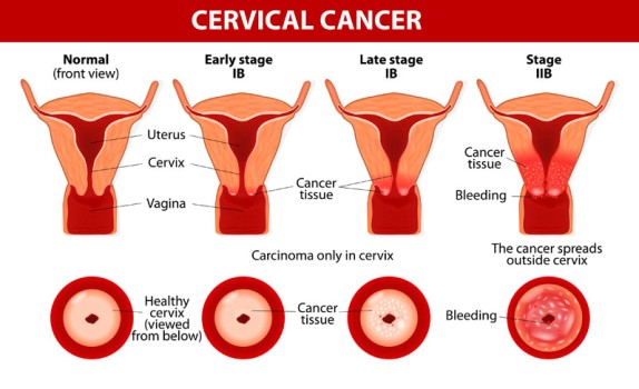 Low Dose Rate Brachytherapy for Cervical Cancer