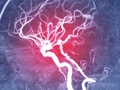 Brain Aneurysms & What to Watch For