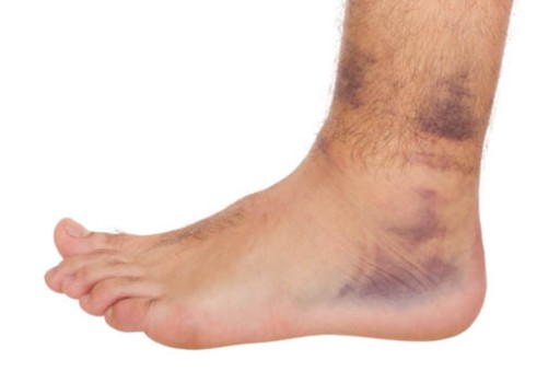 Open Reduction and Internal Fixation of an Ankle Fracture