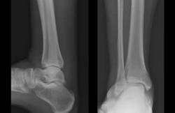 Open Reduction and Internal Fixation of Distal Tibia Fracture