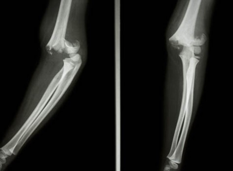 Open Reduction and Pinning for Supracondylar Humerus Fracture