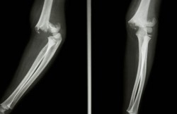 Open Reduction and Pinning for Supracondylar Humerus Fracture
