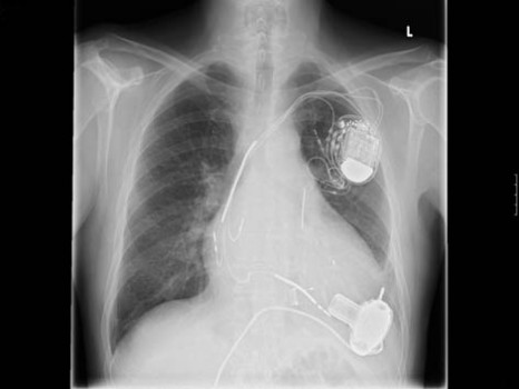 Pacemaker Implant