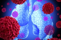Photodynamic Therapy for Lung Cancer