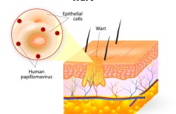 Wart Removal by Laser Therapy