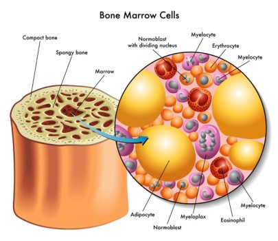 Allogenic Bone Marrow Transplant