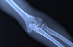 Arthroscopic Elbow Synovectomy