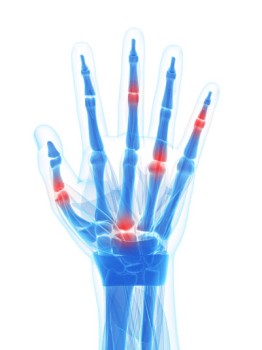 Arthroscopic Finger Synovectomy
