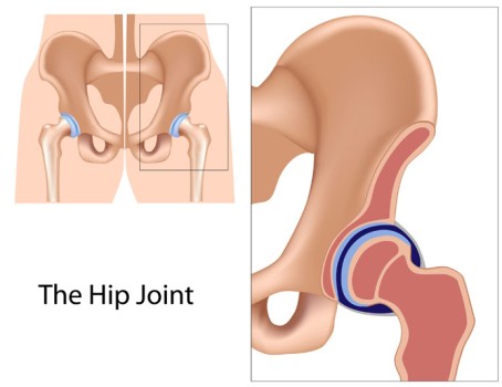 Arthroscopic Partial Hip Replacement