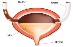 Laparoscopic Burch Procedure for Bladder Neck Suspension