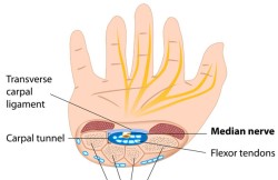 Carpal Tunnel Release