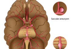 Cerebral Aneurysm Repair by Clipping