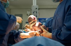 Cesarean Section Delivery