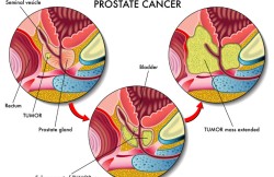 Cryosurgery for Prostate Cancer
