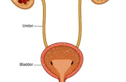 Cystectomy