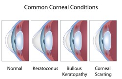 Descemet's Stripping with Endothelial Keratoplasty