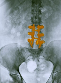 Lumbar Spine Fusion
