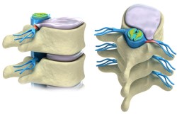 Spinal Disc Replacement Surgery