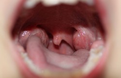 Intracapsular Tonsillectomy