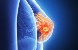 Intracavitary Brachytherapy for Breast Cancer