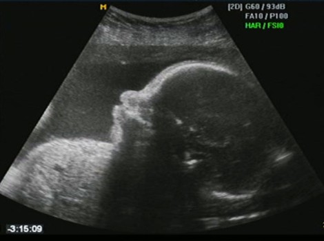 Fetal Image-Guided Surgery