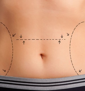 High Lateral-Tension Abdominoplasty