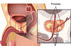 High Dose Rate Brachytherapy for Prostate Cancer 