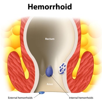 Hemorrhoidectomy