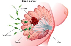 High Dose Rate Brachytherapy for Breast Cancer