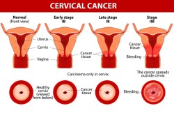 High Dose Rate Brachytherapy for Cervical Cancer